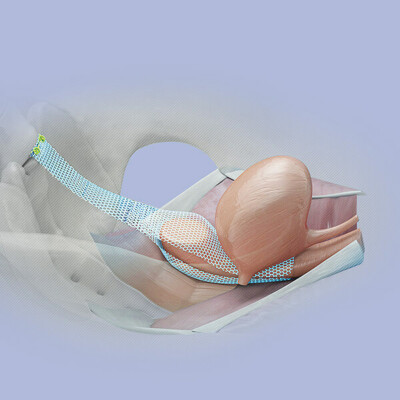 EndoGYNious_3D-400×400-1